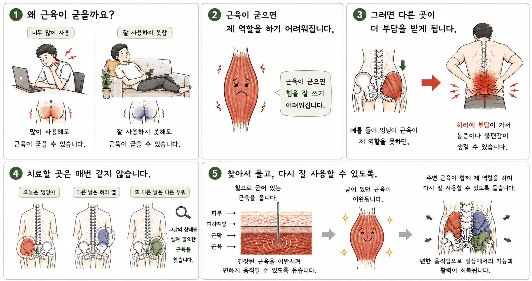 근육이 굳는 원인, 근육 기능 저하, 허리 부담, 치료 부위의 변화와 침치료를 통한 근육 이완을 설명한 만화